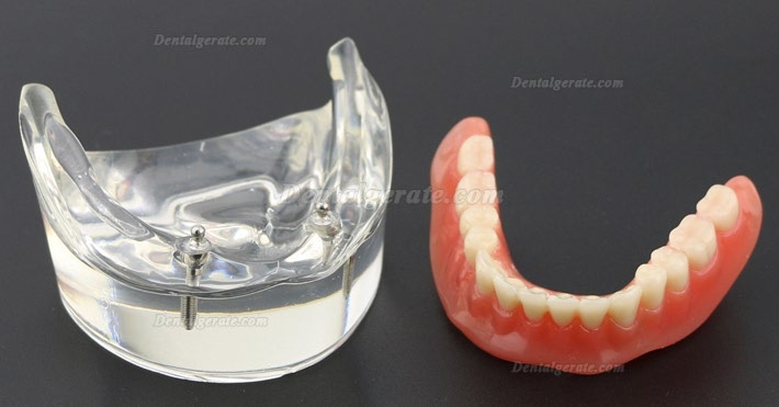 Modell f&uuml;r Zahnz&auml;hne &Uuml;berprothese minderwertig bei 2 Implantaten Demo-Modell 6002 01